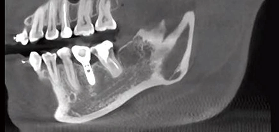CBCT D50