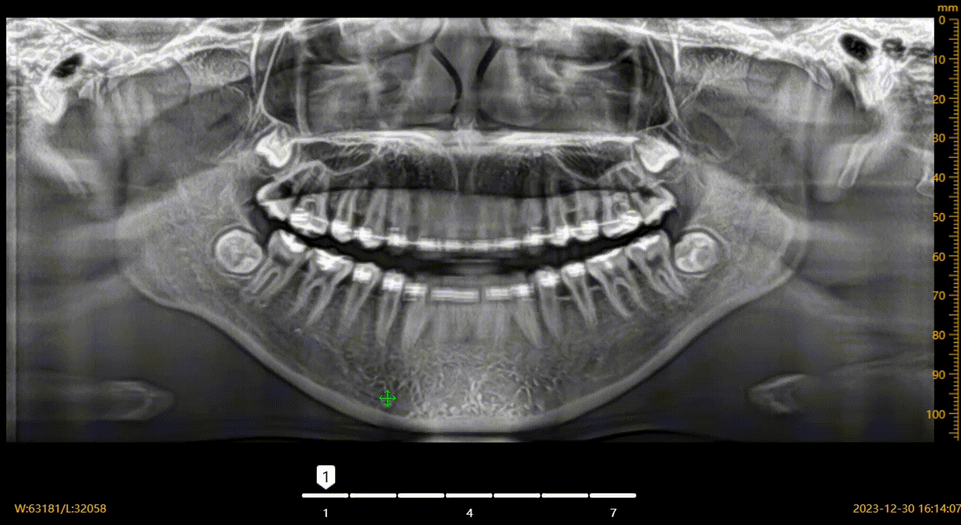 CBCT D50