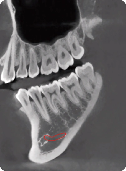 CBCT D50