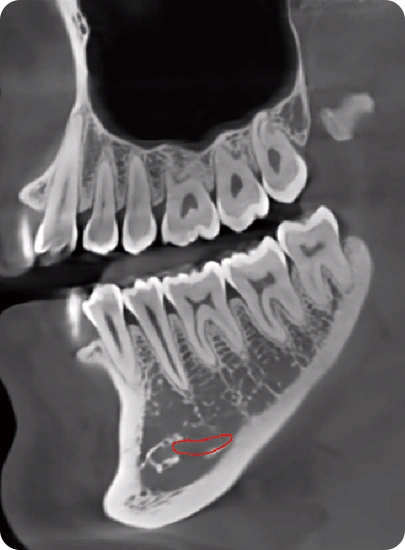 CBCT D50