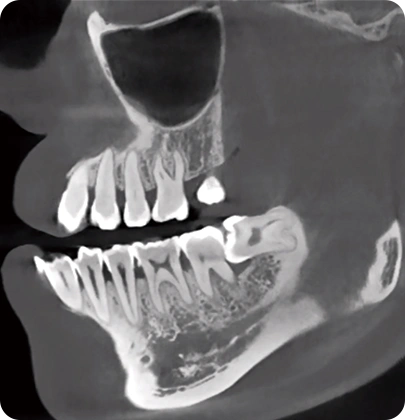CBCT D50