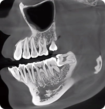 CBCT D50