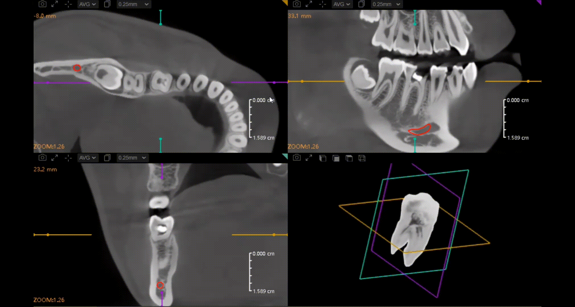 CBCT D50