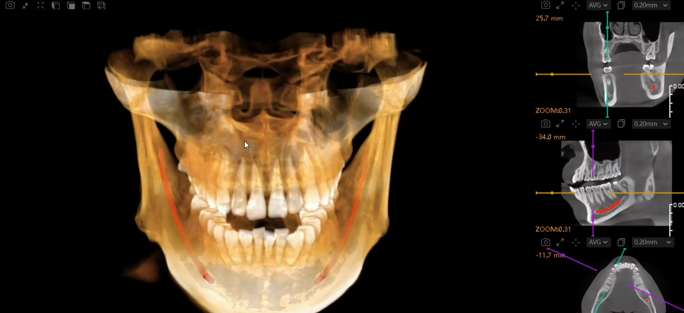 CBCT D50