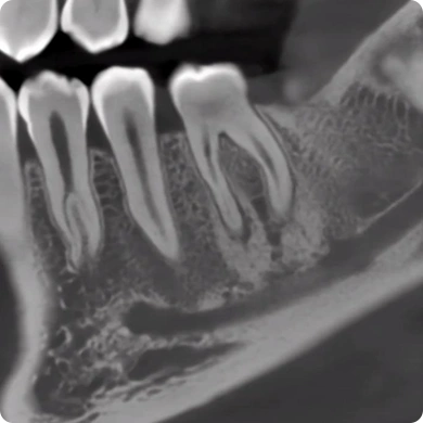 CBCT D50