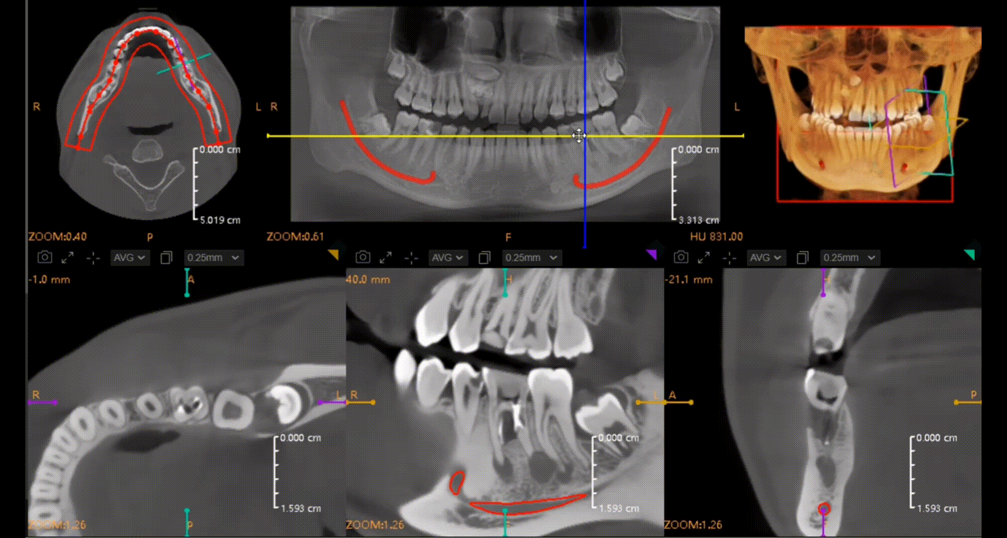 CBCT D50