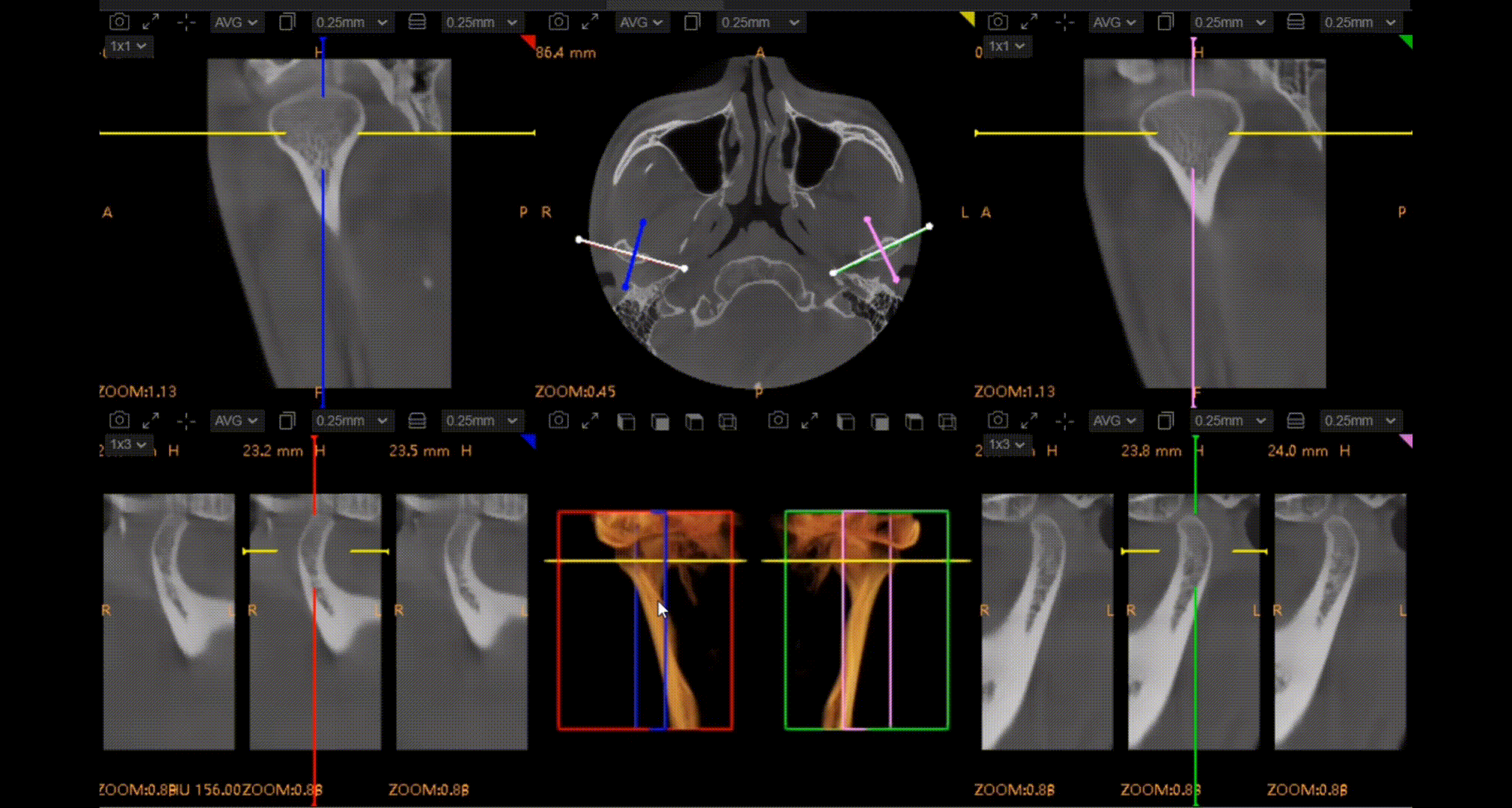 CBCT D50