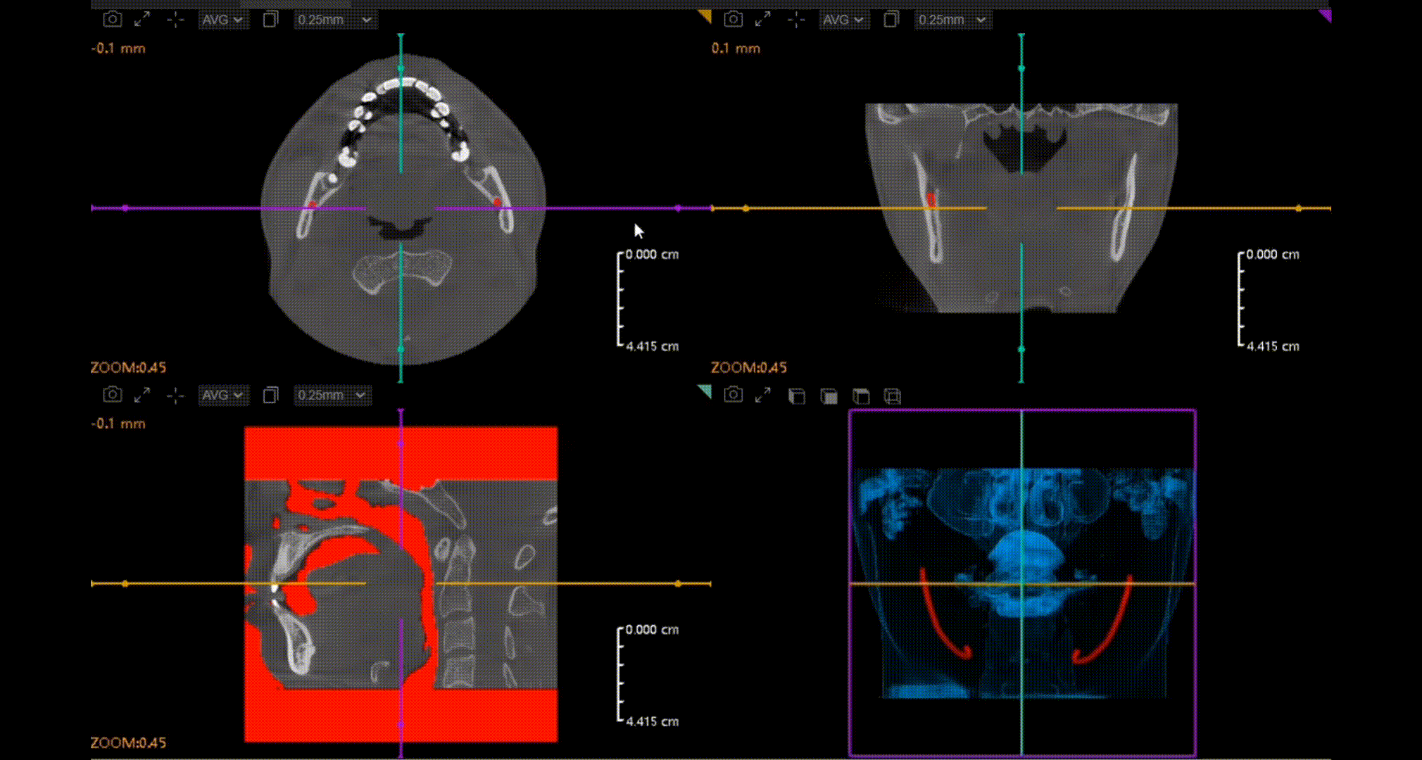 CBCT D50
