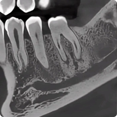 CBCT D50