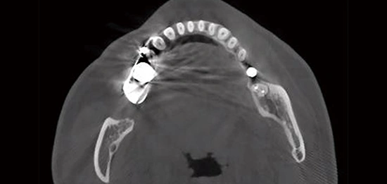 CBCT D50