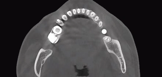 CBCT D50