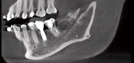 CBCT D50