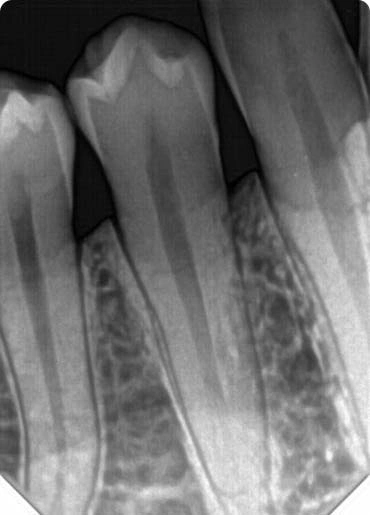 Sensor Intraoral F100