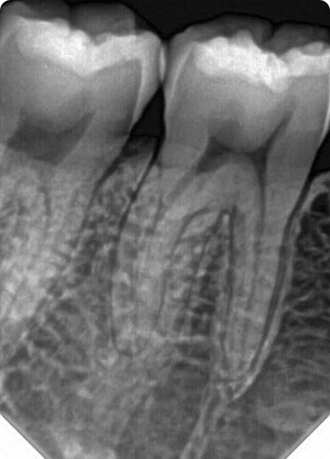 Sensor Intraoral F100