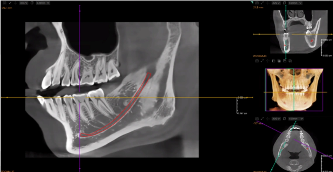 Nervo alveolar inferior com IA