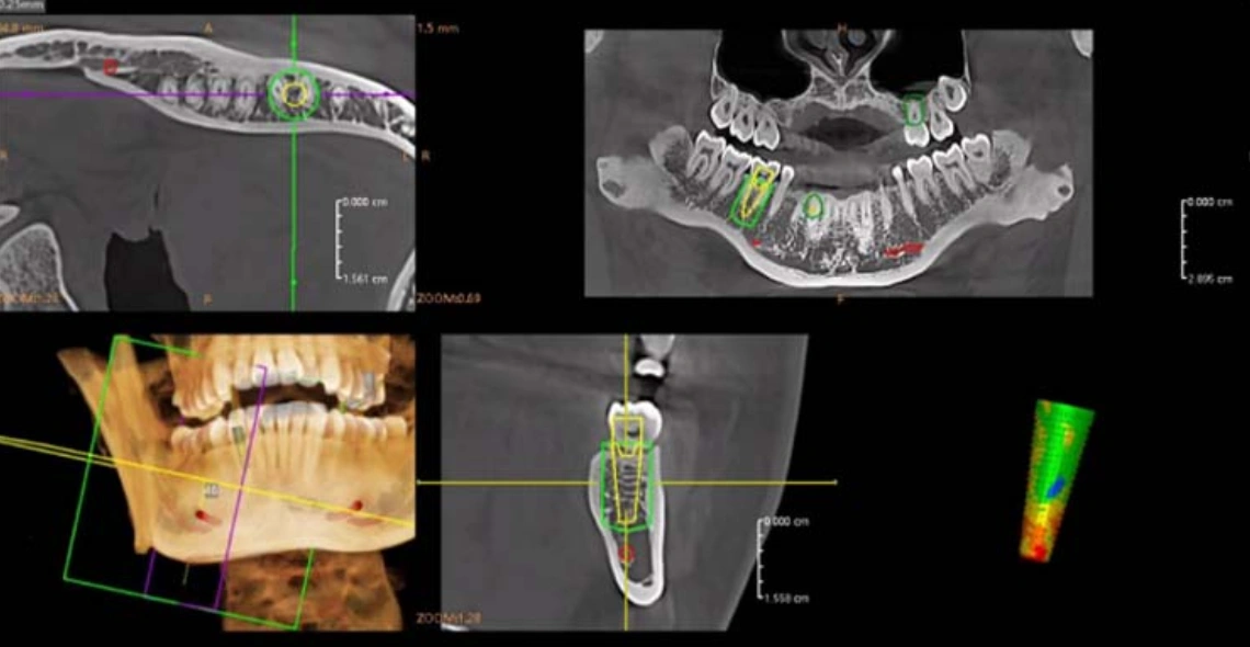 Simulação de implantes num único passo