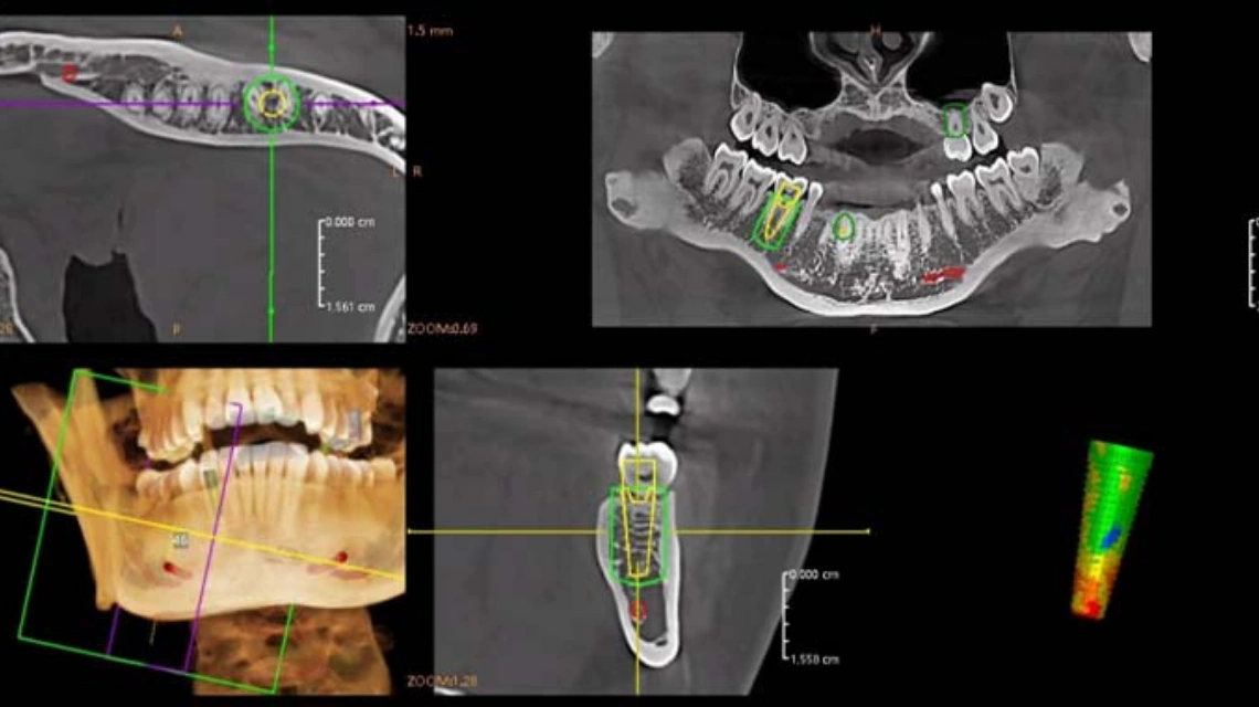 Simulação de implantes num único passo